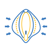 Labioplasty